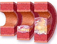 Plaque Buildup